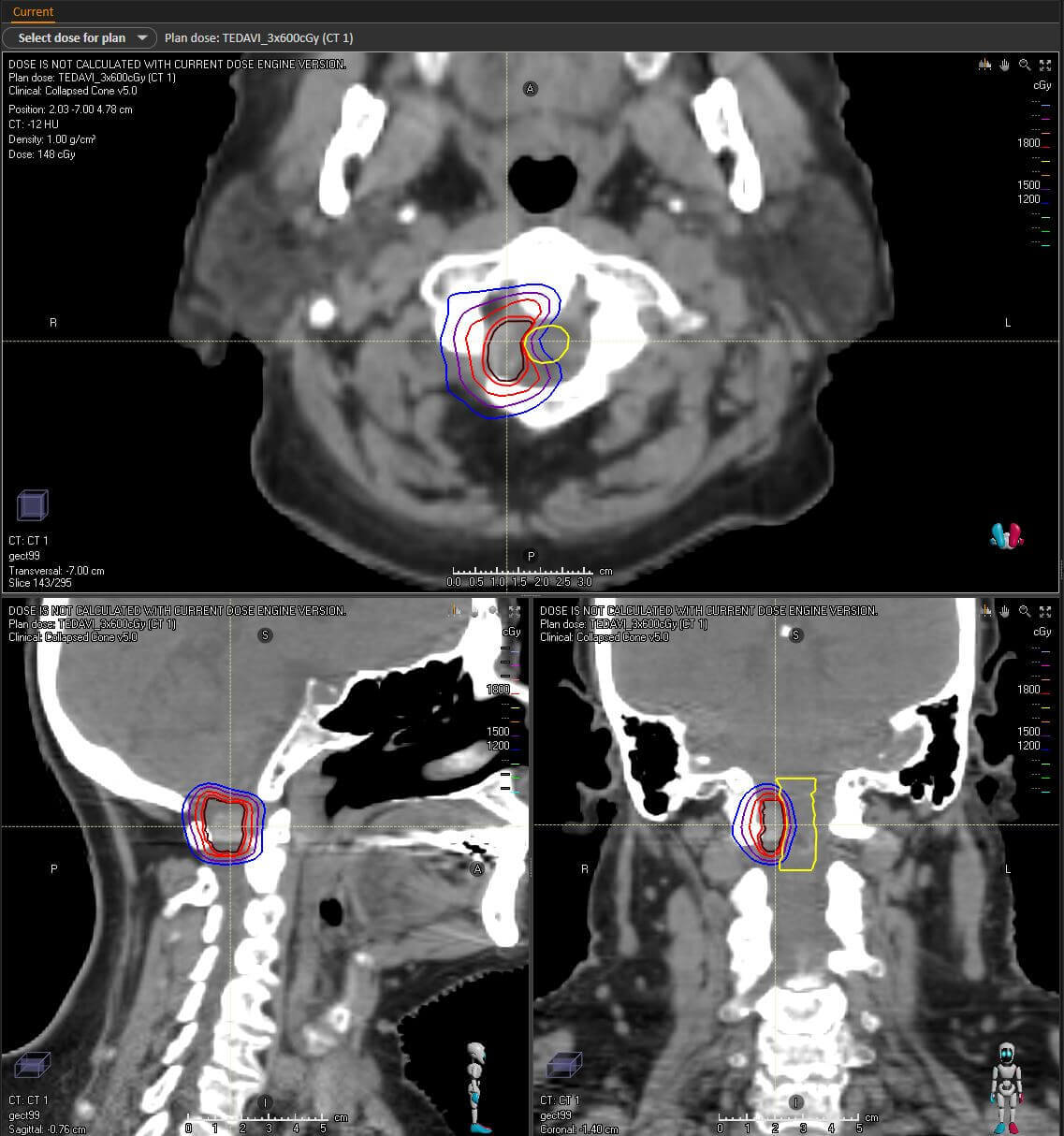 Spinal.JPG Spinal.JPG