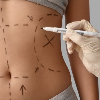 Karın Germe Cerrahisi̇ (Abdominoplasti)